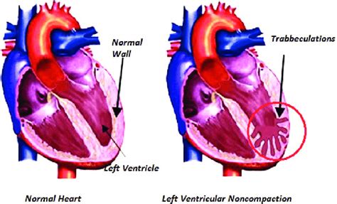 what is Lv noncompaction